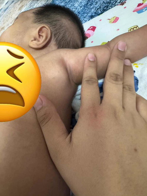 BCG lymphadenitis