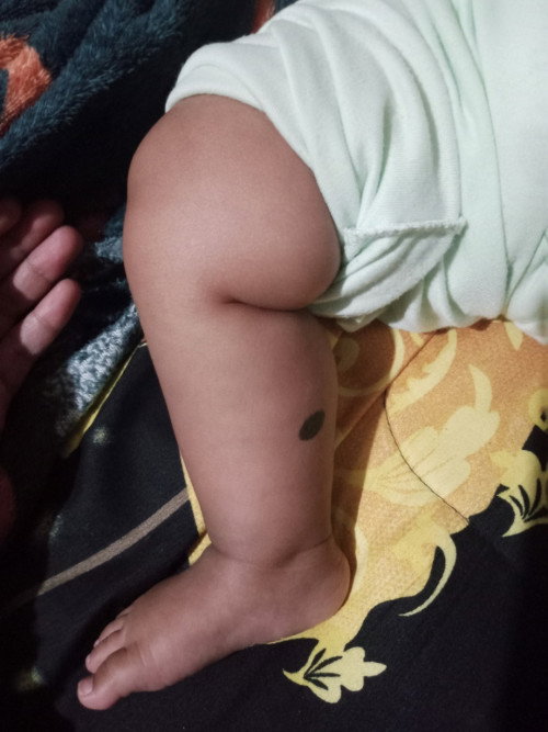 Ada Yang Samakah Anak nya Punya Tanda Lahir Hitam ?