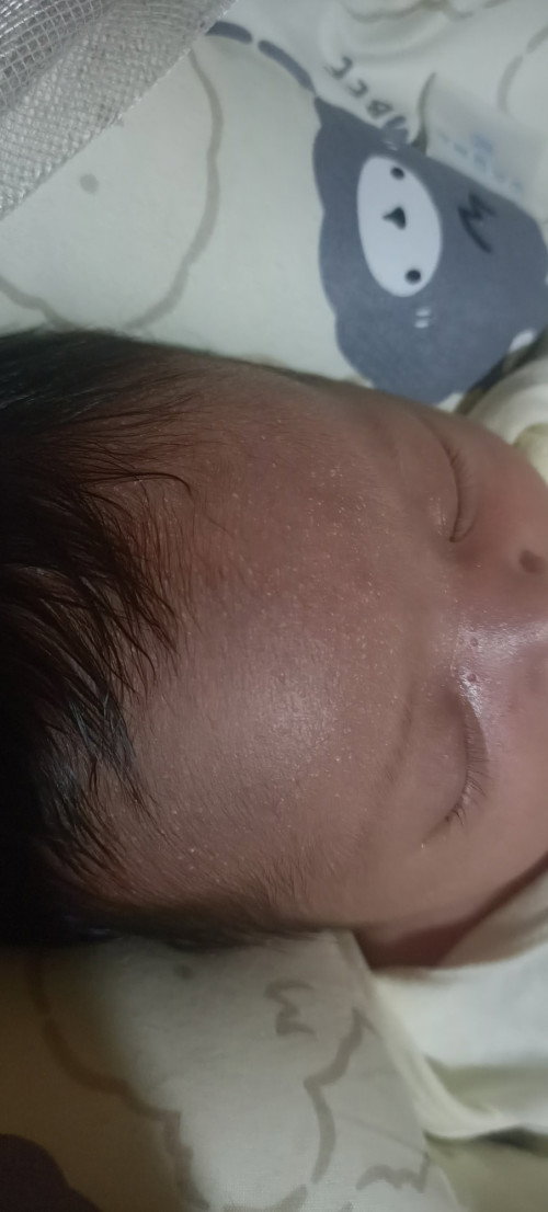ada solusi ga bun? apa bisa ilang sendiri?