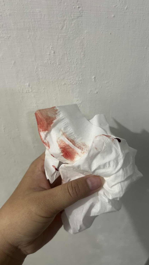 Keluar darah saat BAB