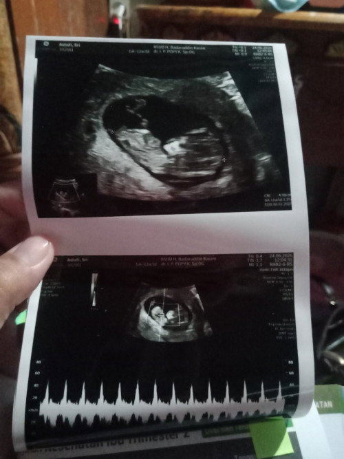 Pengalaman ku saat 12 week hamil