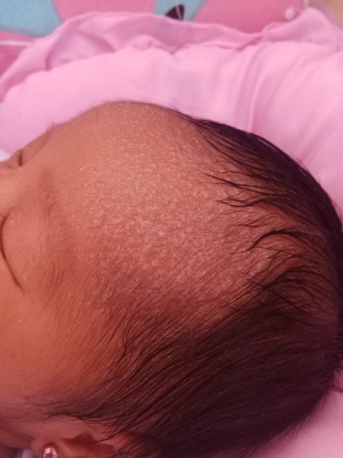 May Puti puti na parang butol sa mukha ni baby