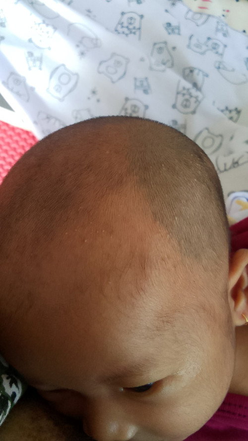 Bintik di kepala