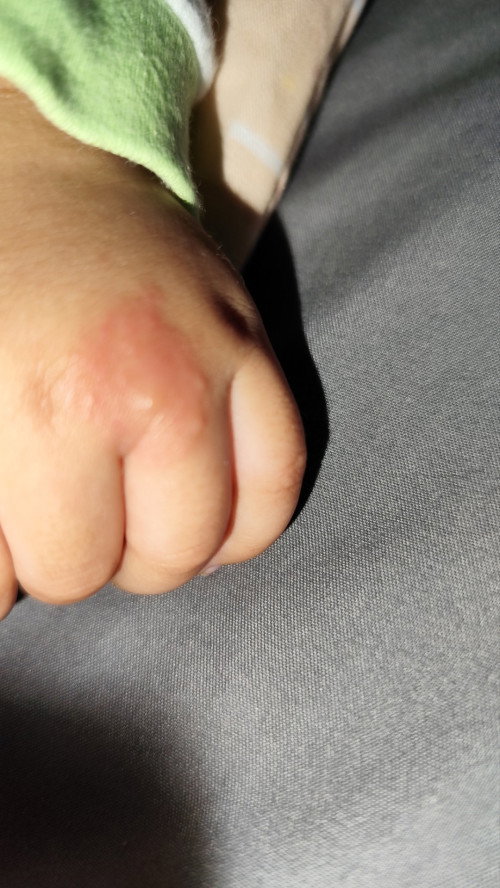 Bentol kecil2 ga ilang