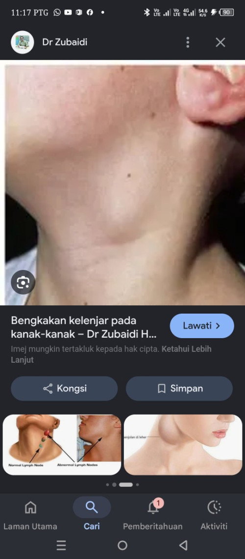 Bengkak leher