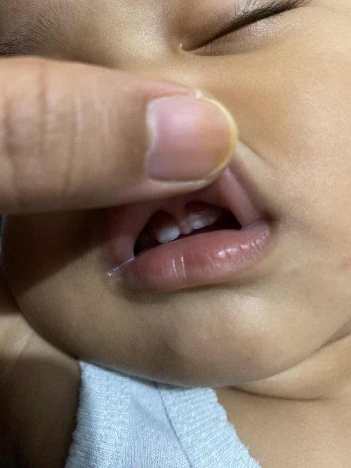 ada ga mommy yg gigi anaknya tumbuh kyk gni?