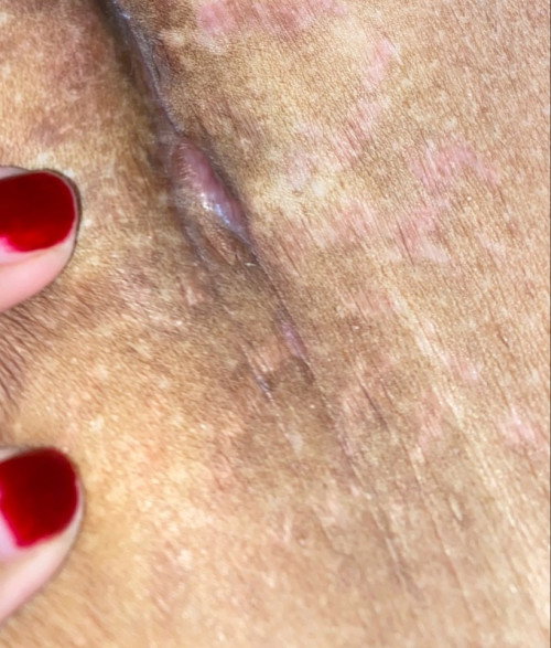 Luka bekas SC 1bulan muncul benjolan luar dalem, apakah ini keloid dan aman..?