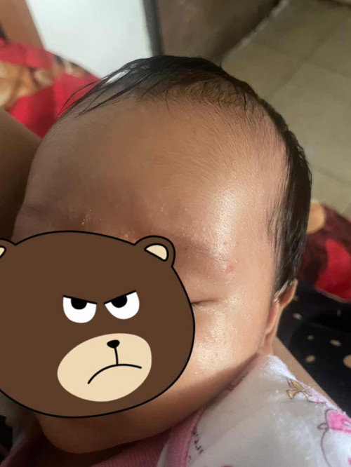 Ruam di wajah dan bentol di badan baby