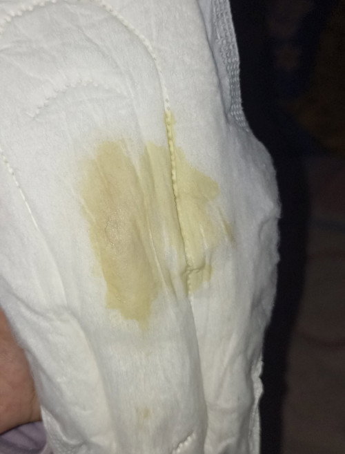 Keluar cairan 
di trimester ketiga ada yg keluar cairan beginikah? Warna kuning sedikit gatal