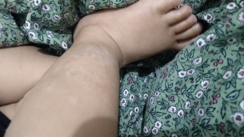 Kulit gatal"