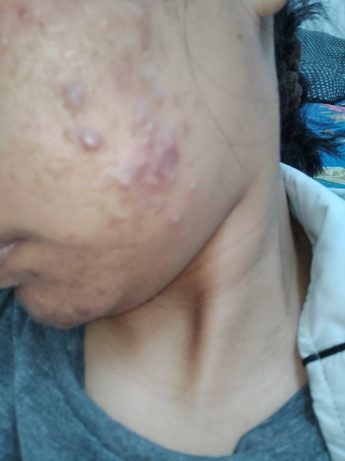 Macammana nak rawat jerawat