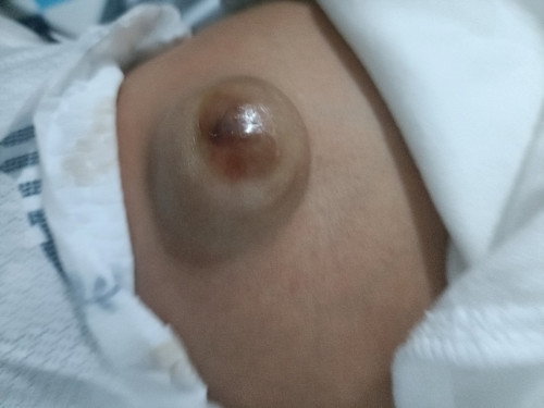 Umbilical Hernia