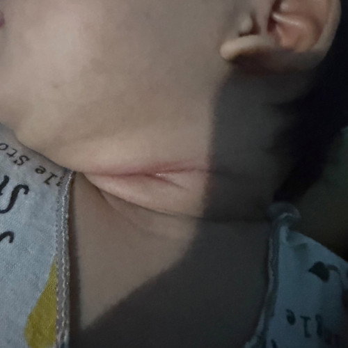 Ruam berbau di lipatan leher