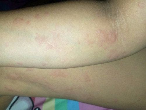 Hello po Good afternoon!!! Ask lng po mga miii ,ano po kaya Ang ibig Sabihin ng rashes na ito?