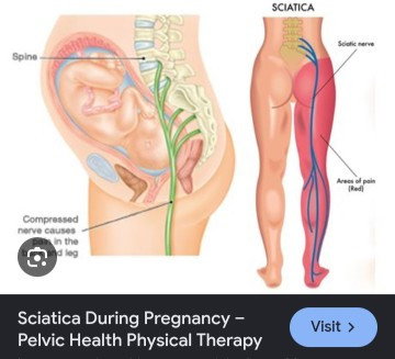 Siatica during pregnancy!