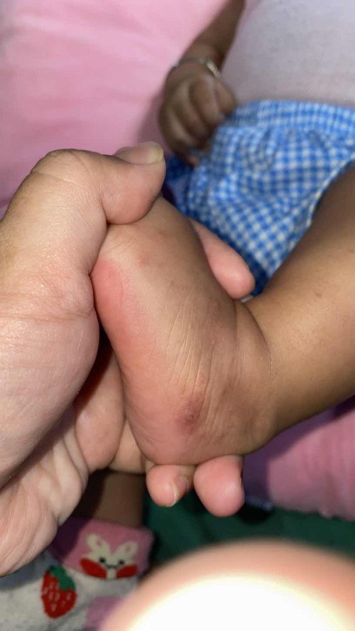 Bantuin dong bun pkai apa biar sembuh bintik berair di kaki dan tangan bayi