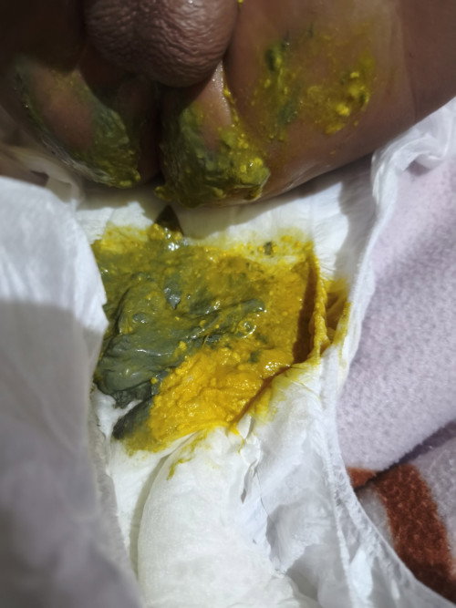 Alergi susu sapi dan soya