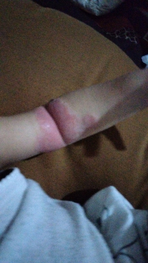 Gatel / ruam keringat