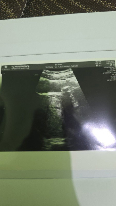 Bentuk kantung janin tidak bulat