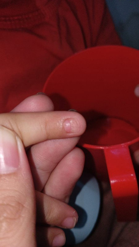 Kuku anak habis kejepit pintu