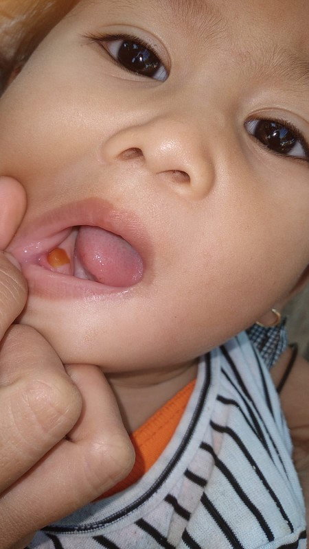 Gusi me merah