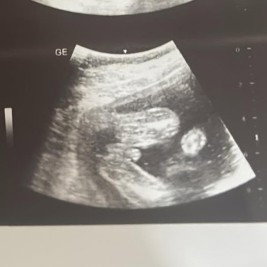 Gender 
Boy or Girl??