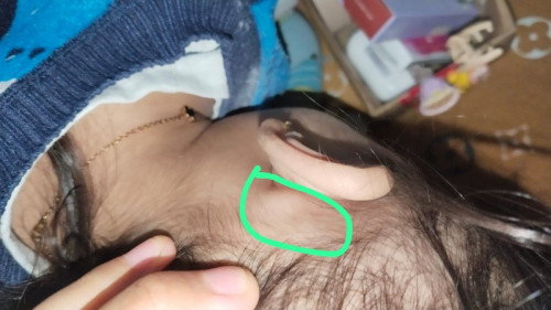 benjolan belakang telinga pada anak 2tahun