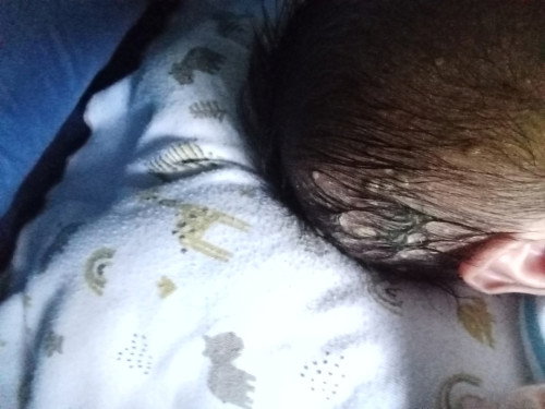 kepala bayi dan d badannya muncul bentol bernanah