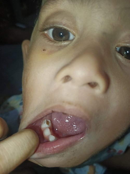 Gigi anak lubang