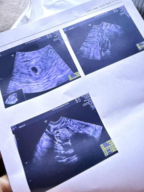 เราจะเป็นท้องลมไหม กังวลและกลัวมาก
#ลูกคนแรก