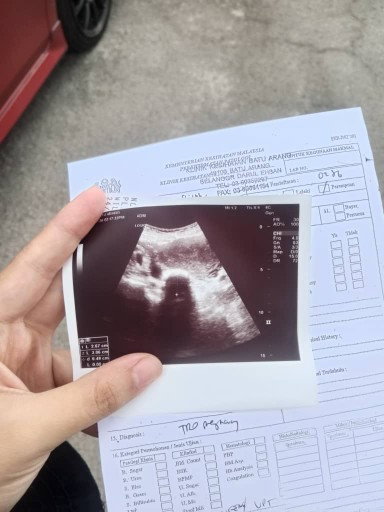 Pelik ke bentuk Cyst saya ?