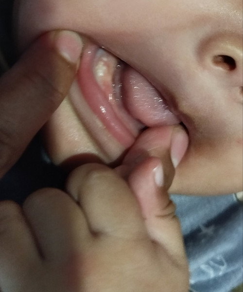 Kenapa bayi saya usia 4bulan 7hari ada bintik putih di gusinya?  Ada yang bisa bantu jawab bun