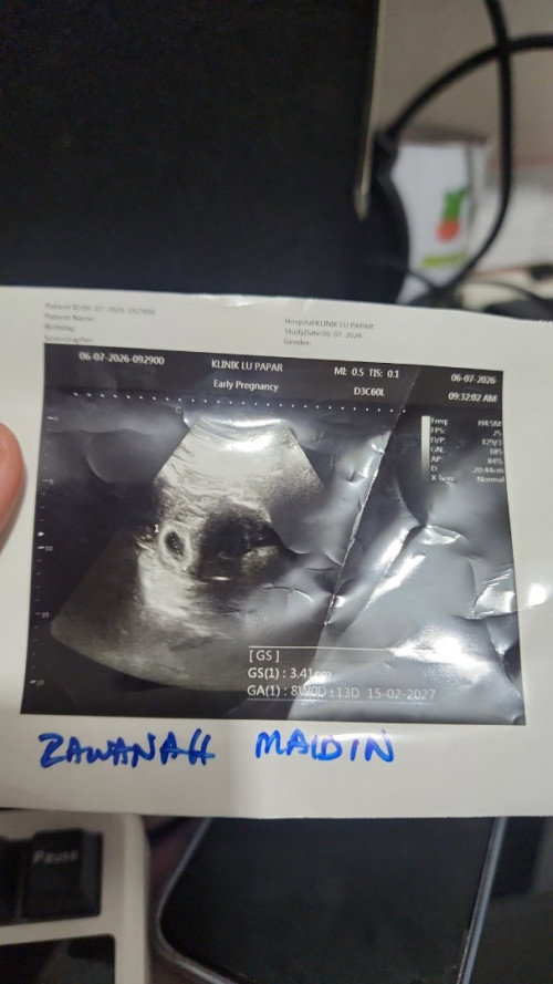 Nurse kkia atau Scan baby ? Mana lagi accurate?