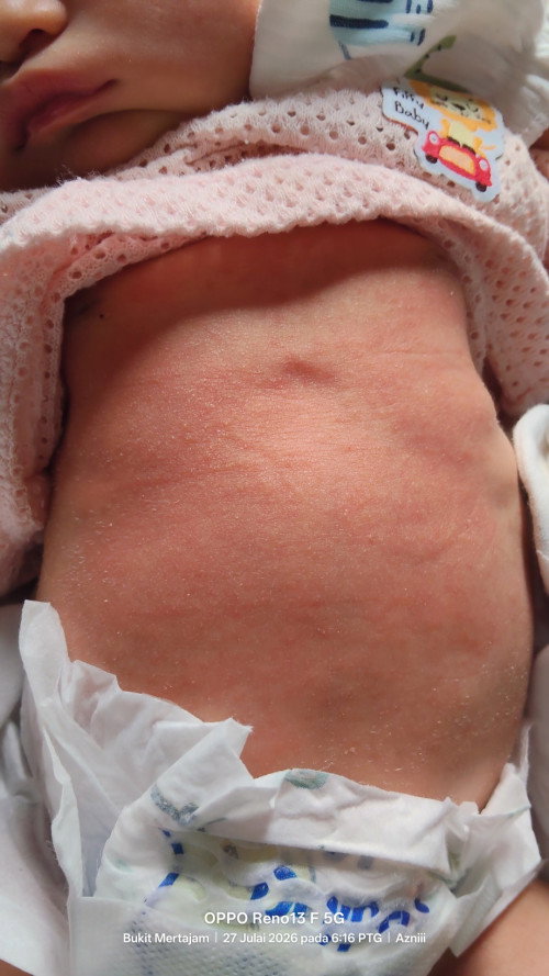 Baby newborn ruam