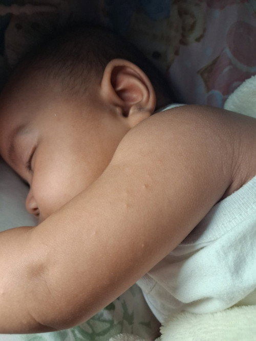 ผื่นแพ้อารายค่ะ