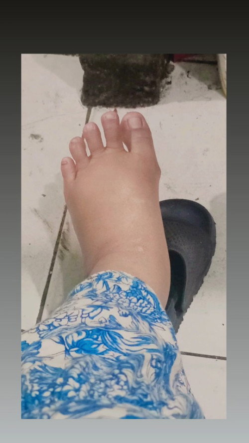Kaki bengkak