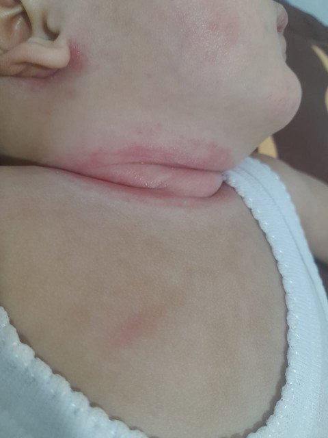 Leher bayi 4 bulan selalu basah dan iritasi merah merah , bagaimana penanganannya?