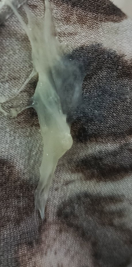 Discharge 20 weeks