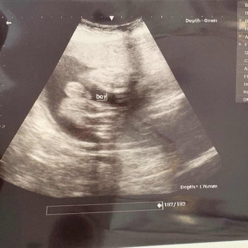 Jantina baby dalam kandungan