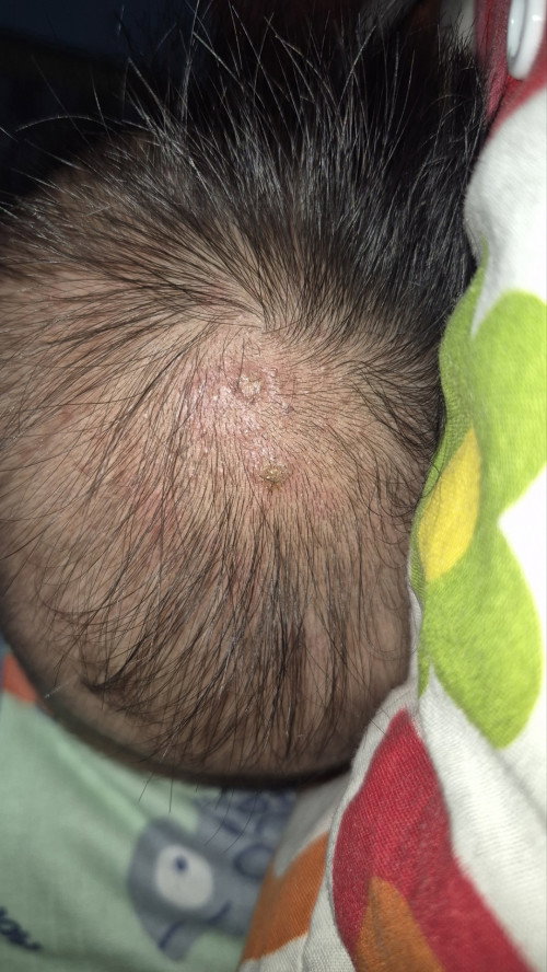 Jerawat kepala bayi