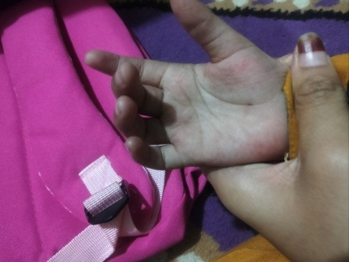 Telapak tangan bintik