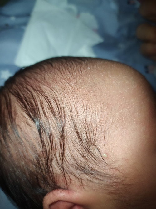 Beruntusan Newborn