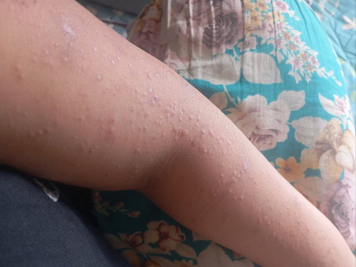 Gatal gatal usia kandungan 26 minggu