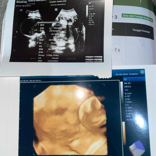 Bbj janin 30week