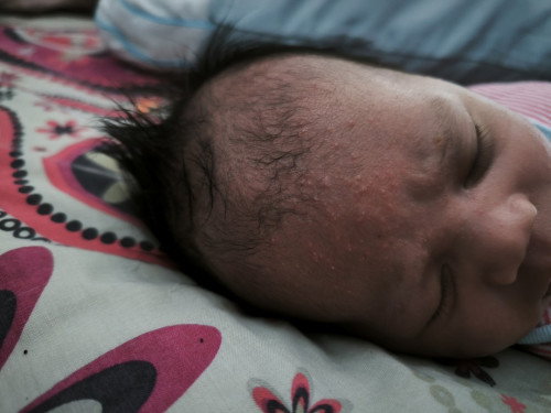 Gatal di dahi bayi
