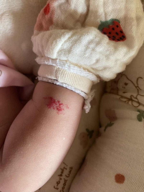 ข้อมือน้องเป็นแบบนี้ แม่คนไหนมีประสบการณ์บ้างค่ะ