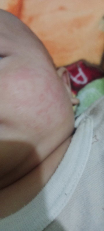 Pipi bayi bruntusan merah sama kering