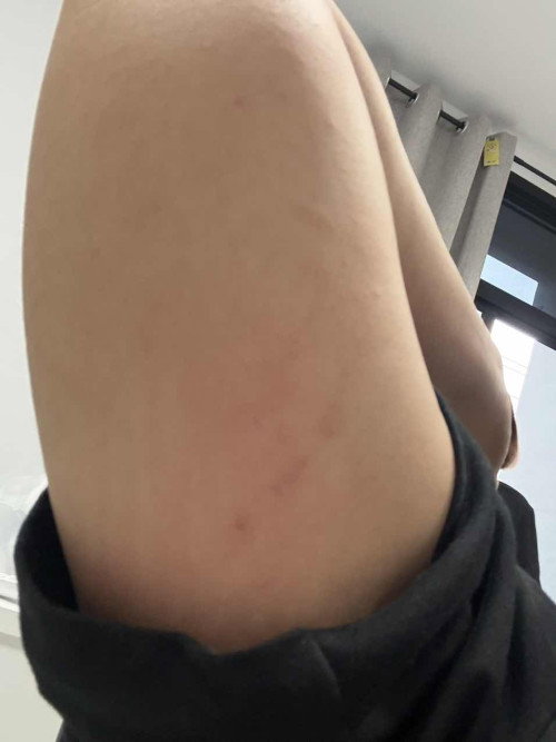 เป็นผื่นหลังเกาอัตรายไหม