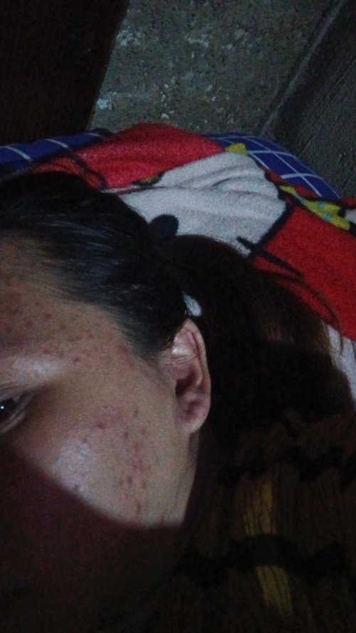 Jerawat saat hamil