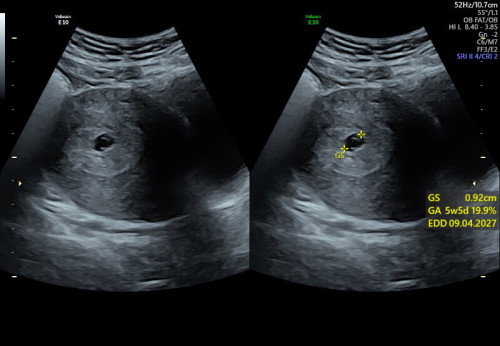 apakah ini blighted ovum?